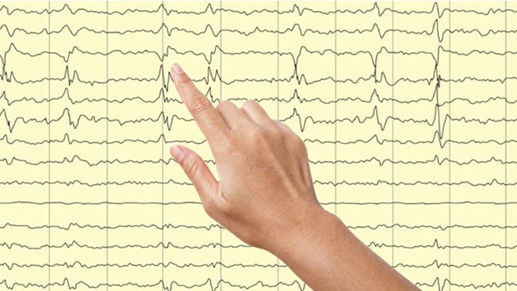 Tìm hiểu Kiến thức Cốt lõi về Điện não đồ (EEG) ở Người lớn