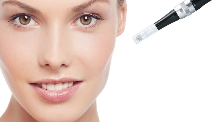 Điều trị Microneedling (kỹ thuật lăn kim vi điểm)